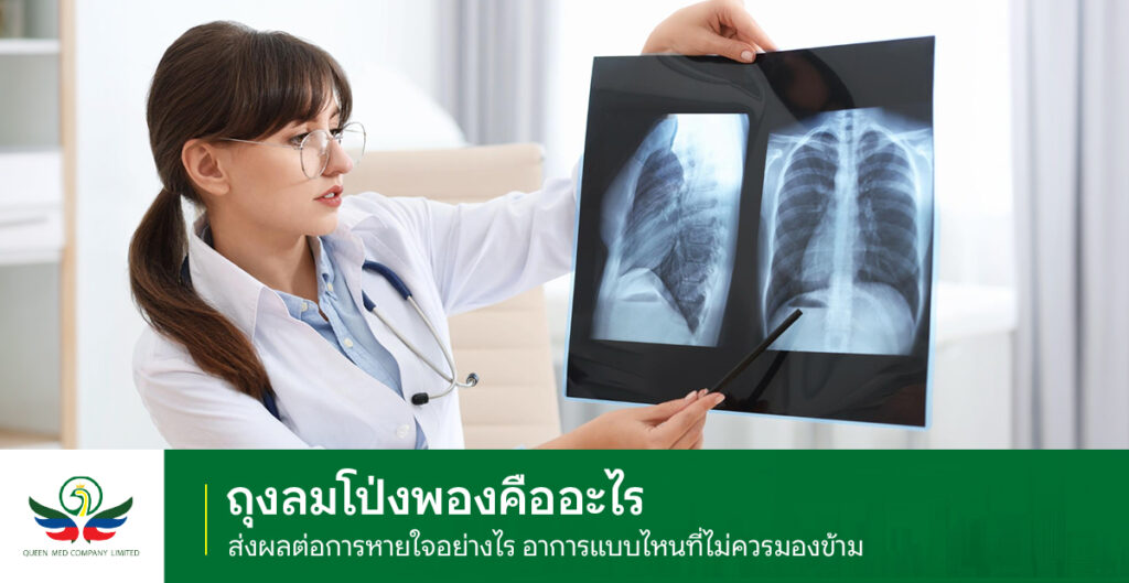 ถุงลมโป่งพอง